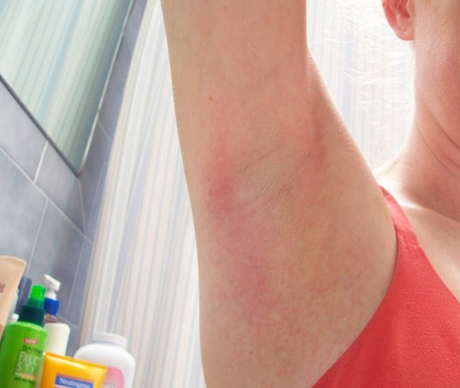 Yeast Rash Under Arms