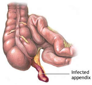 Ruptured-Appendix-Symptoms-300x276
