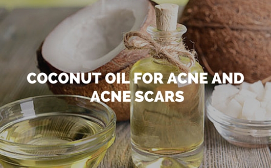 Coconut Oil for Acne and Acne Scars
